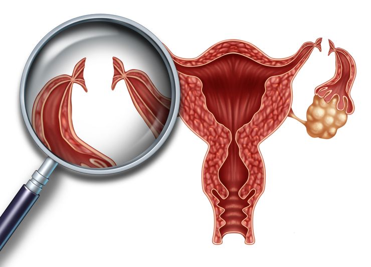 стерилизация женщин
