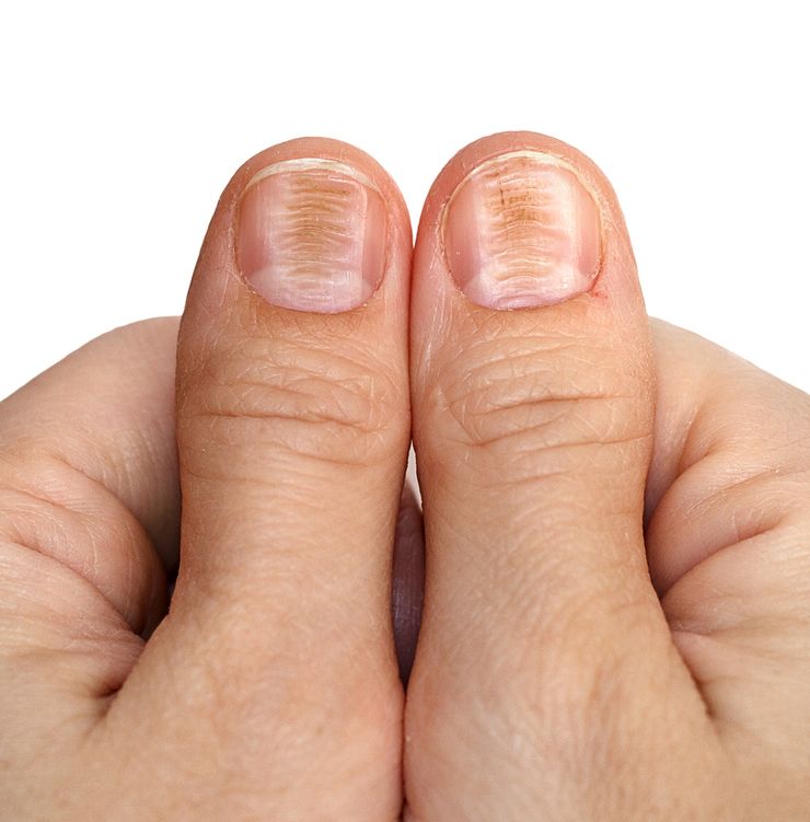 дистрофия ногтя приводит к его изменению