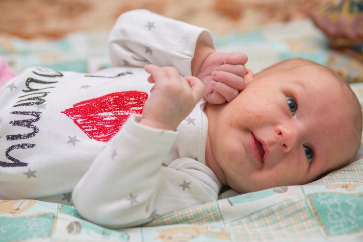Цветение новорожденных: что появляется на коже малыша после рождения
