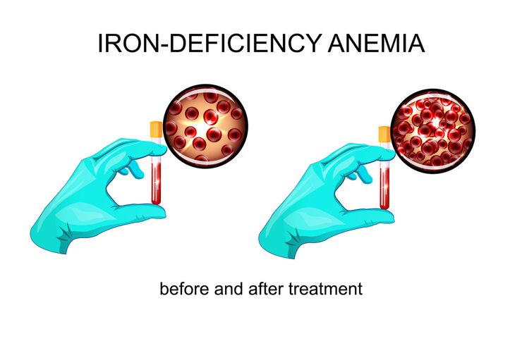 Дефицит железа картинки