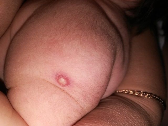 След от бцж? След от бцж?
