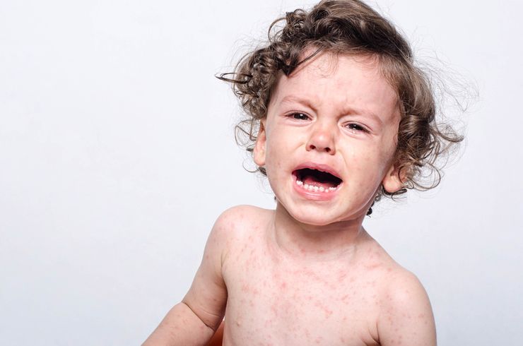 Герпесвирус 6 типа у детей лечение 42