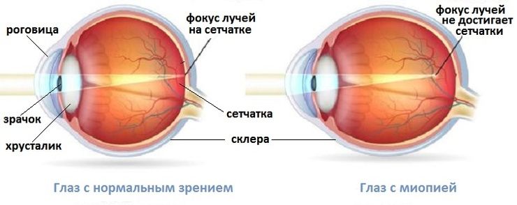 склеропластика глаз у детей