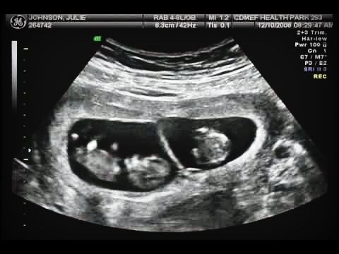 Беременность 12 Недель Двойня Фото Узи