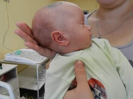 Водянка головного мозга у новорожденных: причины и симптомы
