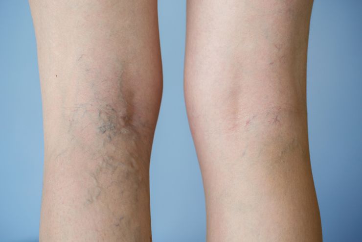 признаки варикоза ног у женщин