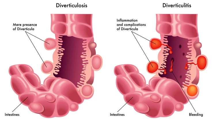 Дивертикулит кишечника
